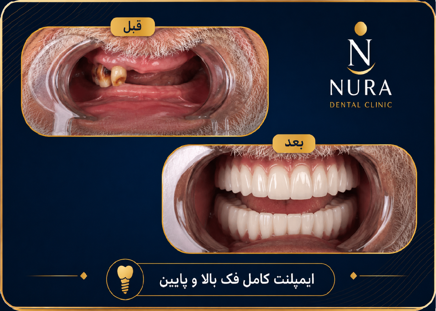 نمونه ایمپلنت دندان در کلینیک نورا