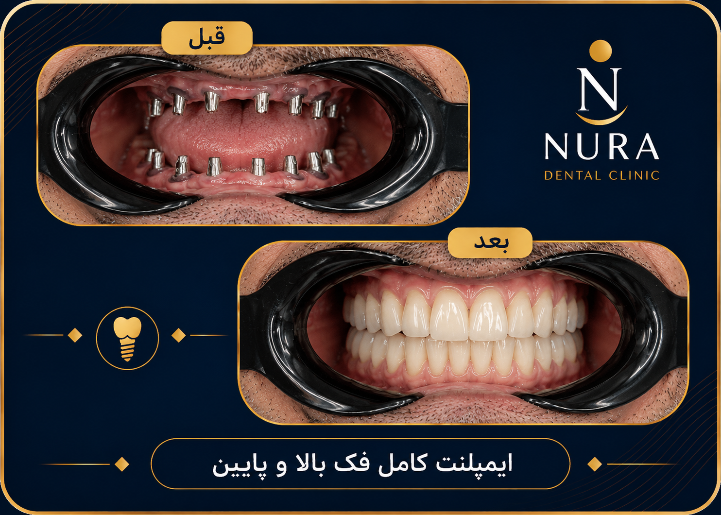 بازسازی لبخند با ایمپلنت دندان