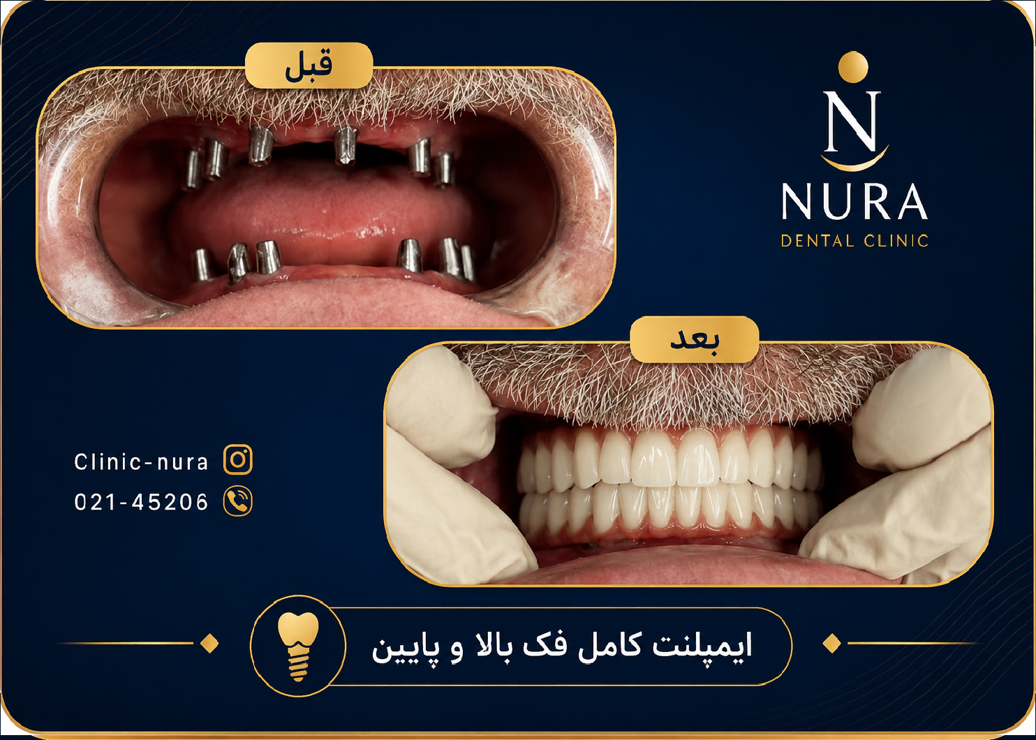 نمونه درمان موفق ایمپلنت در کلینیک نورا