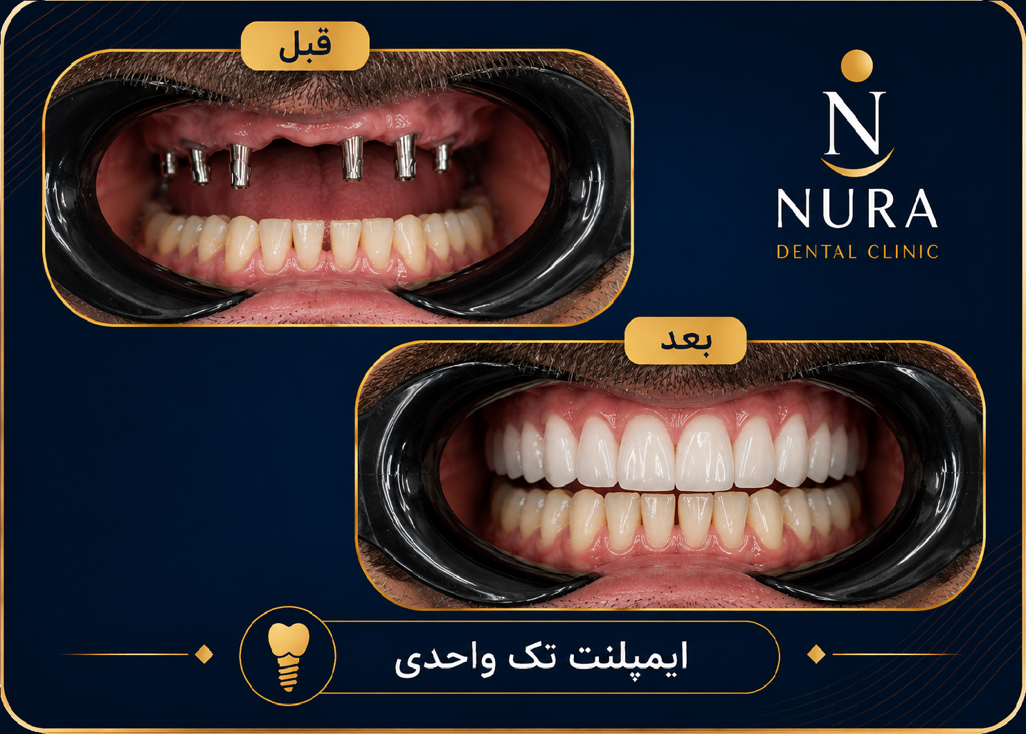 ایمپلنت دندان با تکنولوژی دیجیتال
